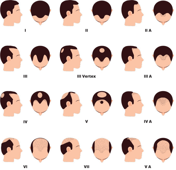 Male Baldness and Attraction: What the Science Says